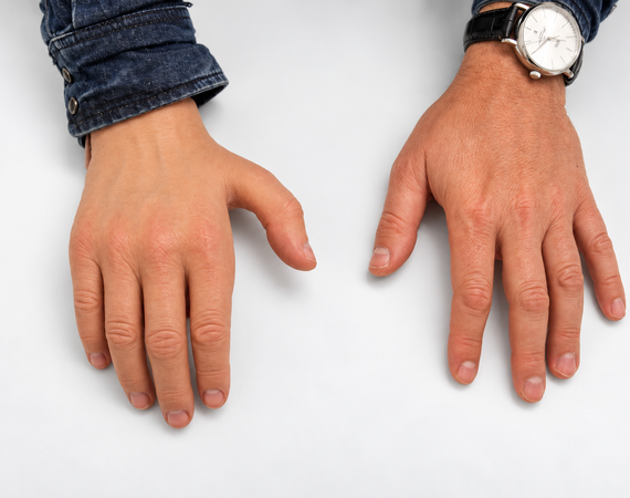 Handprothese